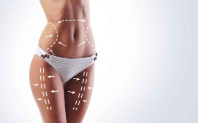 Why More Women Are Choosing Liposuction for Body Confidence
